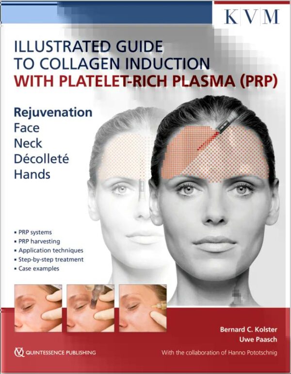 Illustrated Guide to Collagen Induction with Platelet-Rich Plasma (PRP)