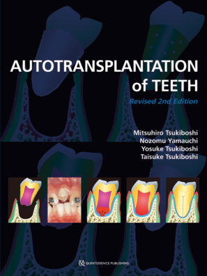 Autotransplantation of Teeth