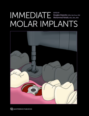 Immediate Molar Implants