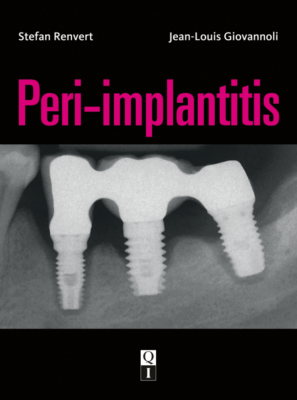 Peri-implantitis